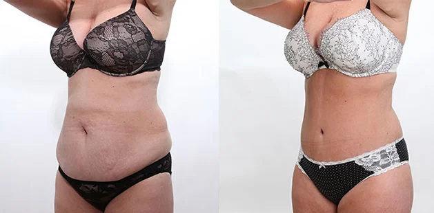 Mommy makeover showing restored body shape and tighter abdomen.