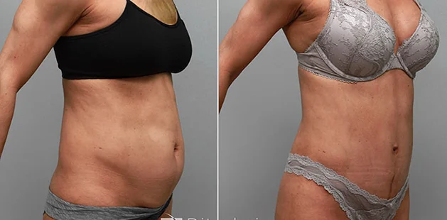 Before and after mommy makeover showing flatter abdomen and lifted breasts at Ditesheim Cosmetic Surgery.