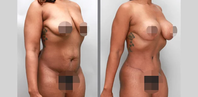 Mommy makeover showing restored body shape and tighter abdomen.