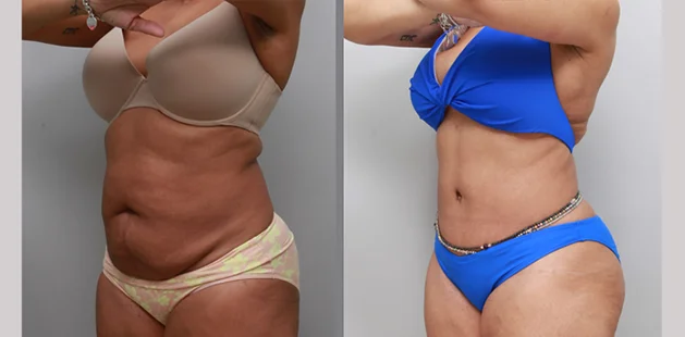 Before and after mommy makeover results showing flatter midsection and enhanced breast contour.