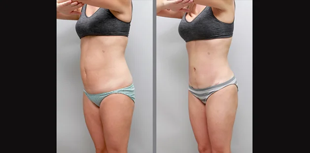 Plastic surgery before and after results showing full-body contouring for moms.