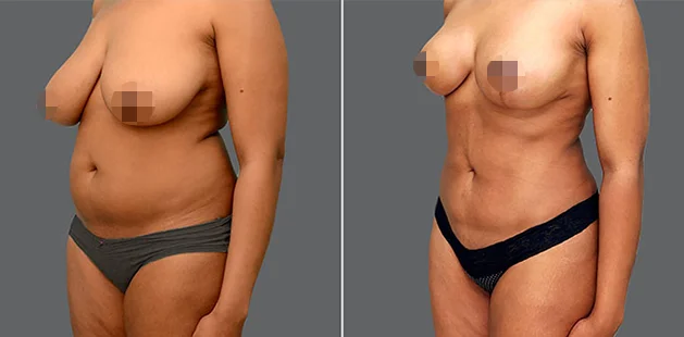 Before and after mommy makeover showing flatter abdomen and lifted breasts at Ditesheim Cosmetic Surgery.