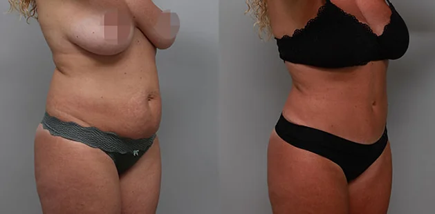 Mommy makeover with tummy tuck and breast lift results.