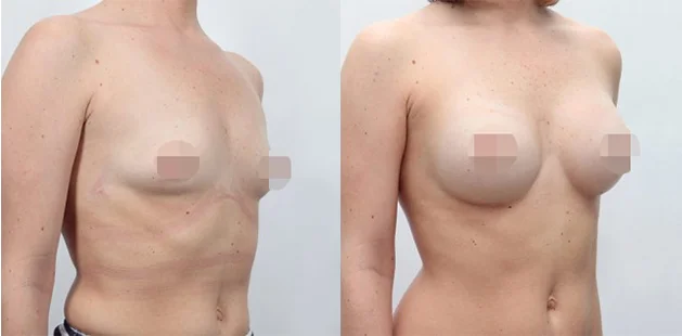 Breast enhancement results with smooth, proportional contour after augmentation.