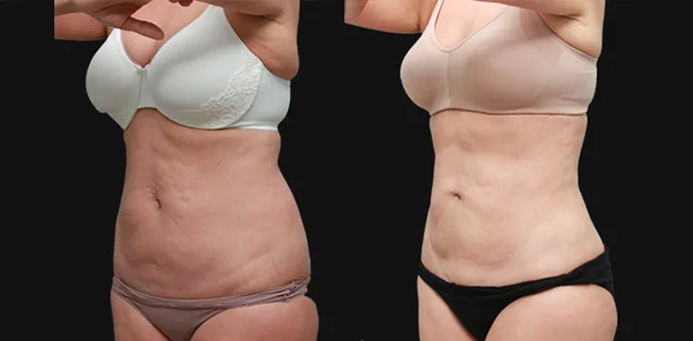 Ditesheim Cosmetic Surgery mommy makeover with tummy tuck and breast lift results.