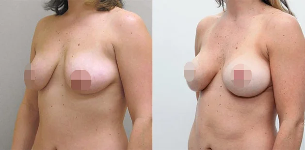 Breast lift procedure results at Ditesheim Cosmetic Surgery showing youthful, balanced enhancement.