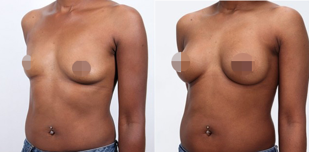 Breast implant enhancement with improved shape and projection before and after.