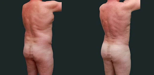 Back view of male liposuction results showing reduced fat and improved back contour.
