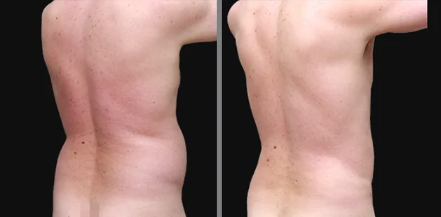 Quarter-back view of male liposuction results showing reduced fat and improved back contour.