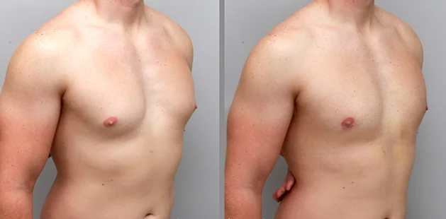 quarter chest