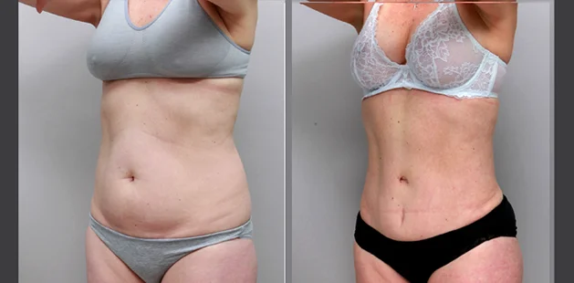 Plastic surgery before and after results showing full-body contouring for moms.