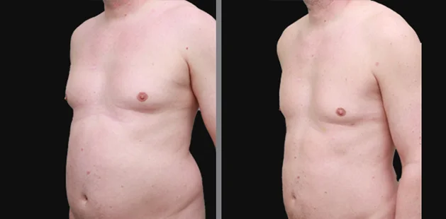 Male side liposuction before and after results showing reduced fat and improved definition.