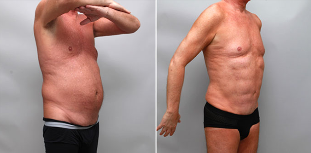 Male liposuction before and after, quarter-front view, highlighting reduced abdominal fullness and improved muscle tone.