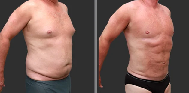 Quarter-side view of male liposuction results showing reduced fat and improved back contour.