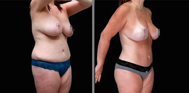 Mommy makeover before and after transformations showing flatter abdomen and improved curves.