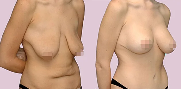 Before and after mommy makeover results showing flatter midsection and enhanced breast contour.