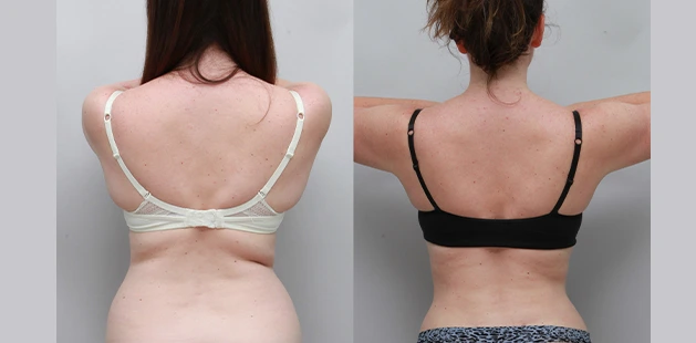 Before and after mommy makeover with liposuction and body contouring showing smoother, defined back and waistline.