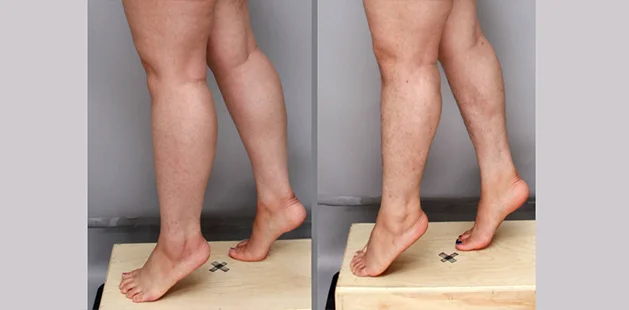 Before and after lipedema surgery showing improved lower leg contour and reduced swelling around calves and ankles.