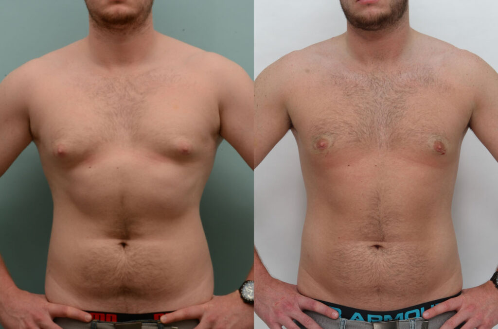 Male body sculpting results at Ditesheim Cosmetic Surgery Charlotte