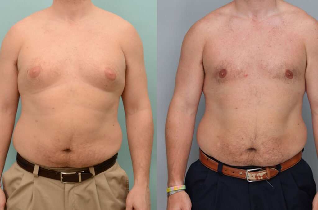 Before and after gynecomastia reduction showing improved chest shape and muscle visibility