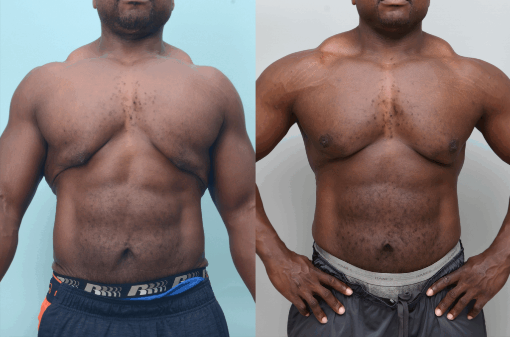 “Before and after male gynecomastia correction showing improved upper body contour and natural masculine appearance | Ditesheim Cosmetic Surgery Charlotte