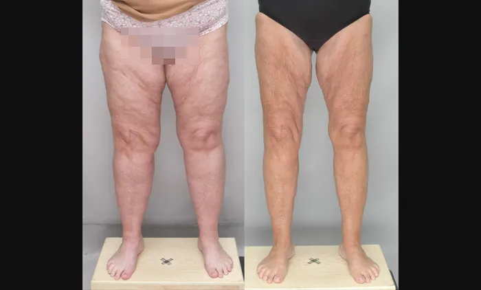 Lipedema treatment WK front view copy