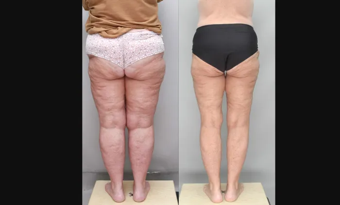 Lipedema treatment WK rear view before and after surgery copy