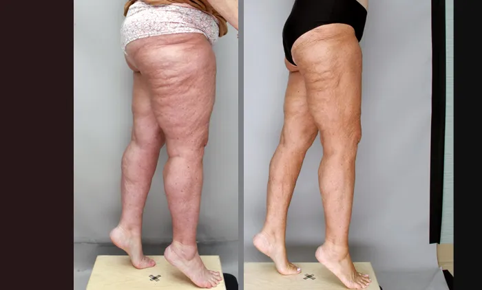 Lipedema treatment lateral thighs WK after surgery adn GLP copy
