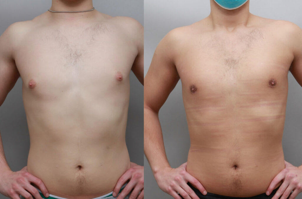 Male cosmetic results at Ditesheim Cosmetic Surgery Charlotte
