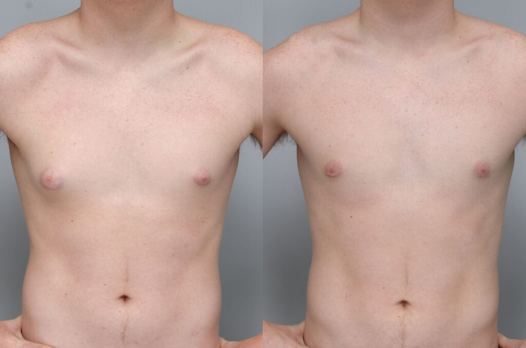 Before and after gynecomastia treatment showing balanced chest contour and restored confidence | Male cosmetic results at Ditesheim Cosmetic Surgery Charlotte