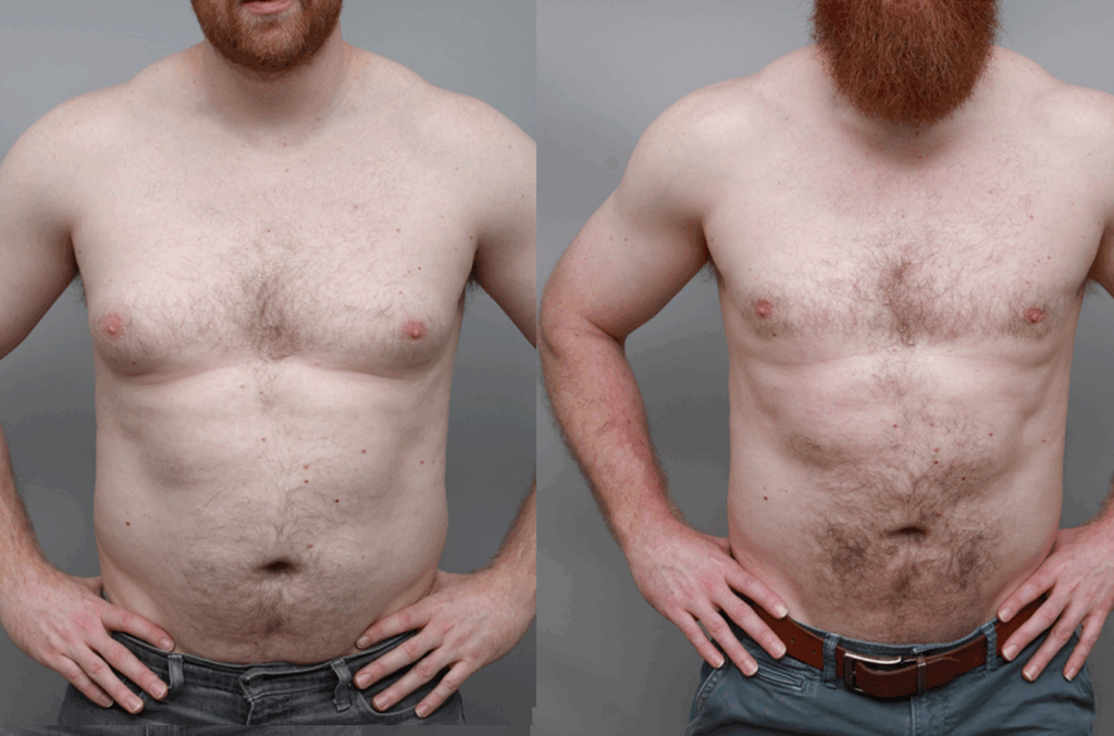 Before and after male chest sculpting demonstrating more defined pectoral area and natural proportions