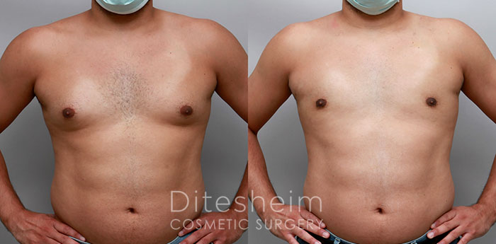 Male's nude torso before and after gynecomastia, front view