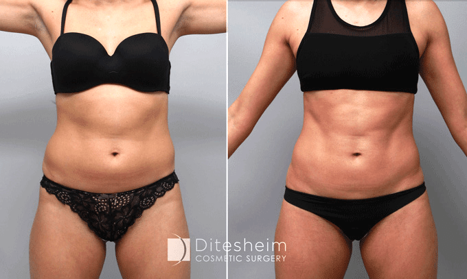 Female's body before and after HD liposuction, front view