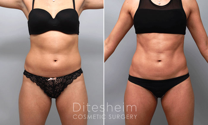 Woman's body before and after Liposuction in Abdomen with Hi definition technique, front view