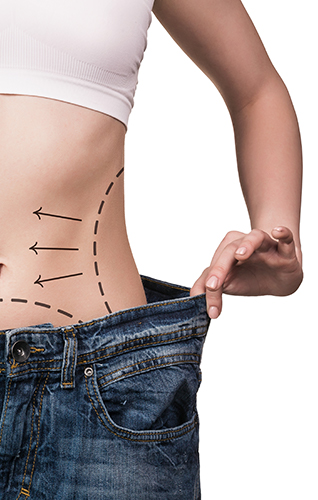 woman showing the waist of a pants that is loose, and her waist marked with dotted lines prior to surgery