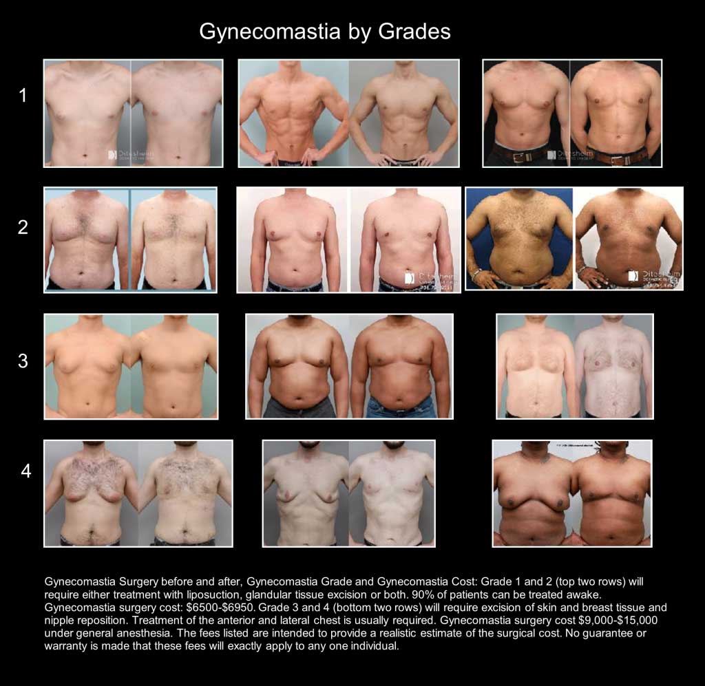 Poster explaining and showing Gynecomastia by grades
