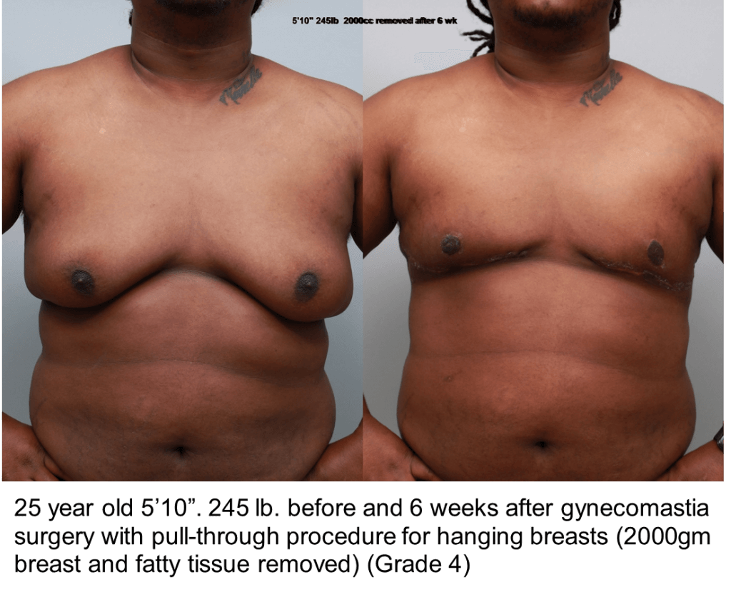 Man's chest before and after gynecomastia with pull through technique, front view