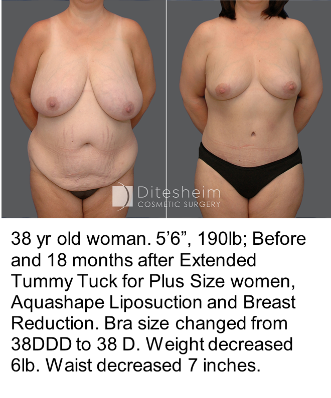 Woman's body before and after mommy makeover, front view