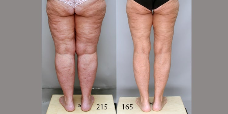 Lipedema Surgery Charlotte NC