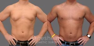Gynecomastia surgery specialist in Charlotte NC
