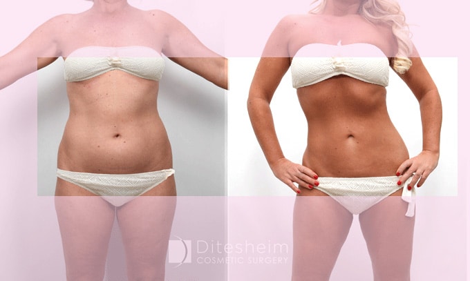 Side-by-side comparison of a female patient's midsection before and after a tummy tuck procedure, showing a flatter abdomen and improved contour.