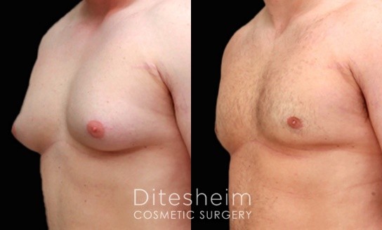 Gynecomastia after prohormones without blocker - Charlotte, NC