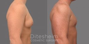Gynecomastia surgery before and after Charlotte NC