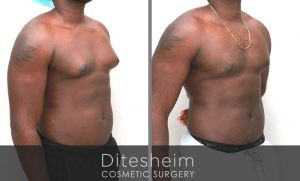 Gynecomastia with VaserLipo and Glandular Excision