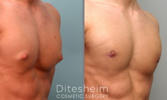 Gynecomastia with puffy nipples