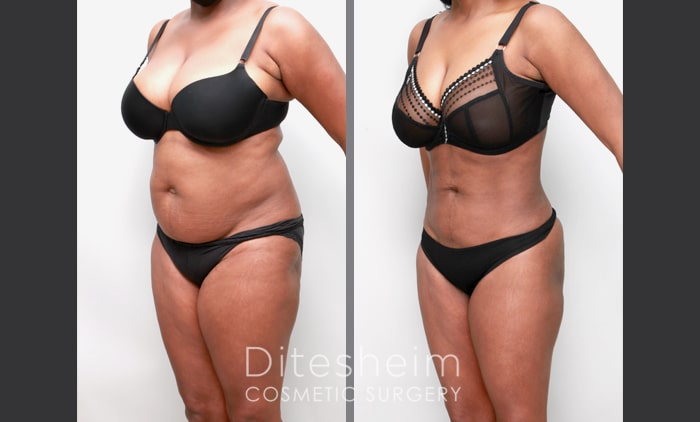 Before and after comparison from a three-quarter view showing a patient's abdomen transformation and improved body contouring following a tummy tuck.