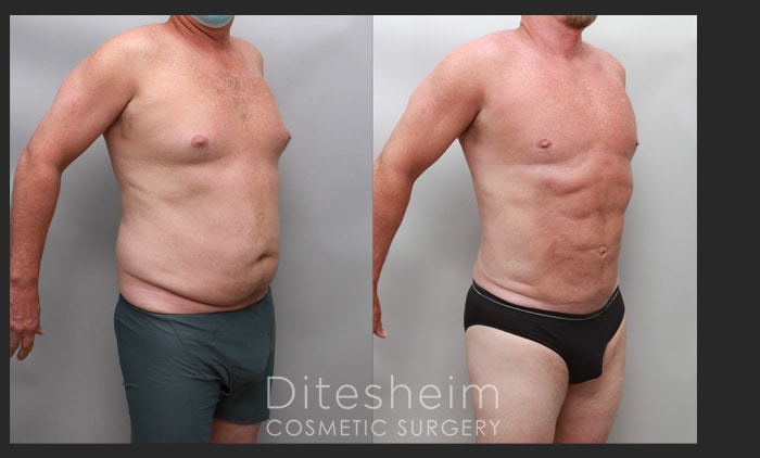 Side-by-side before and after comparison of a male patient showing significant abdominal definition and torso contouring following a cosmetic procedure.