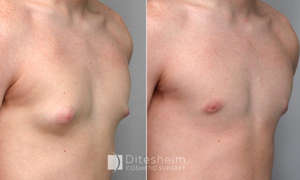 Pro-hormone Gynecomastia Charlotte NC, Ditesheim Cosmetic Surgery