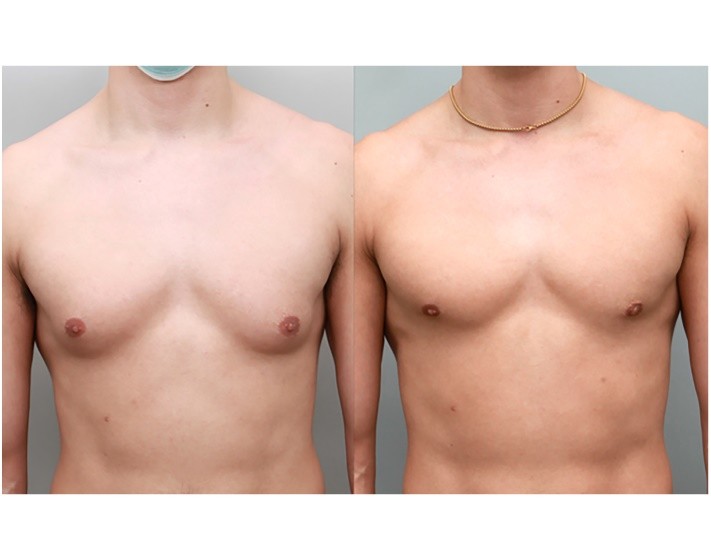 Treatment of Gynecomastia with preservation of chest shape