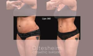 A before and after liposuction side-view comparison of a patient who underwent Lipo 360, showing enhanced abdominal definition and a more contoured waistline.